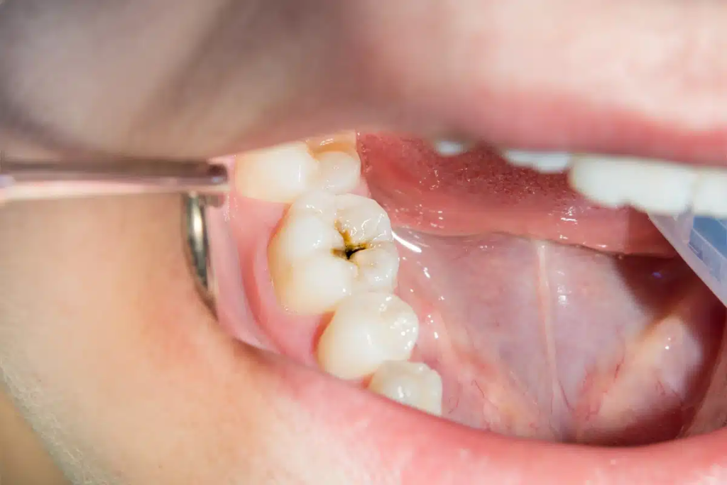 What Happens if Cavities Are Left Untreated