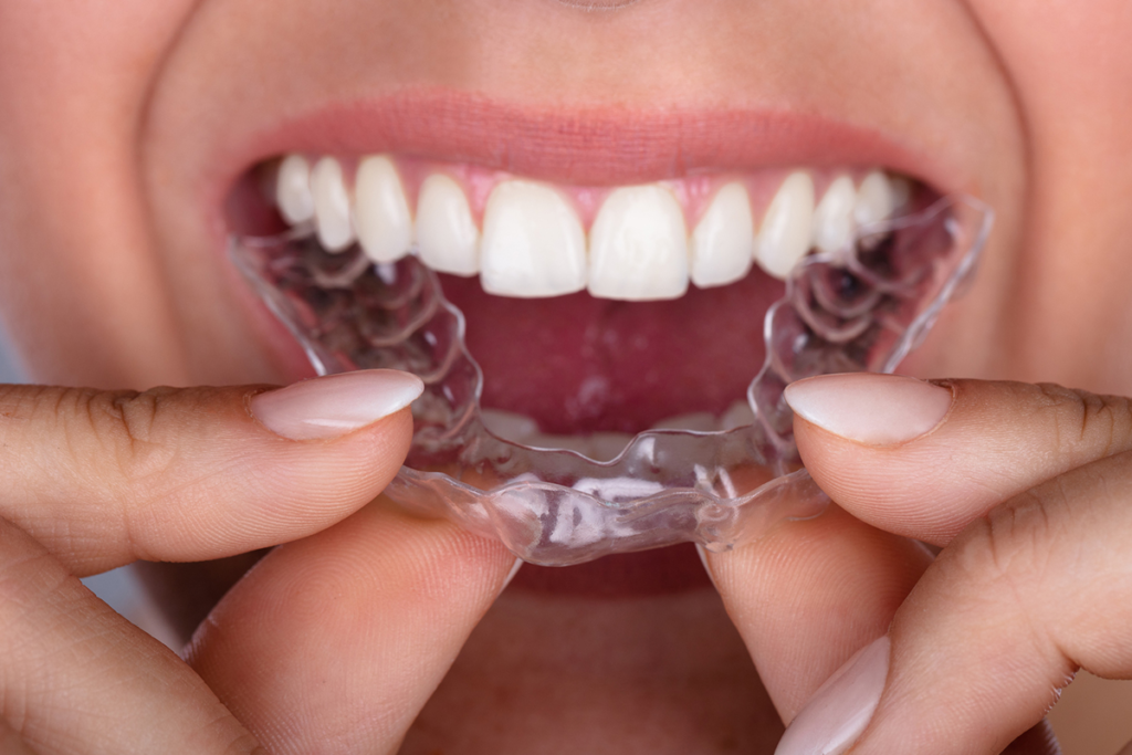 Invisalign Retainer