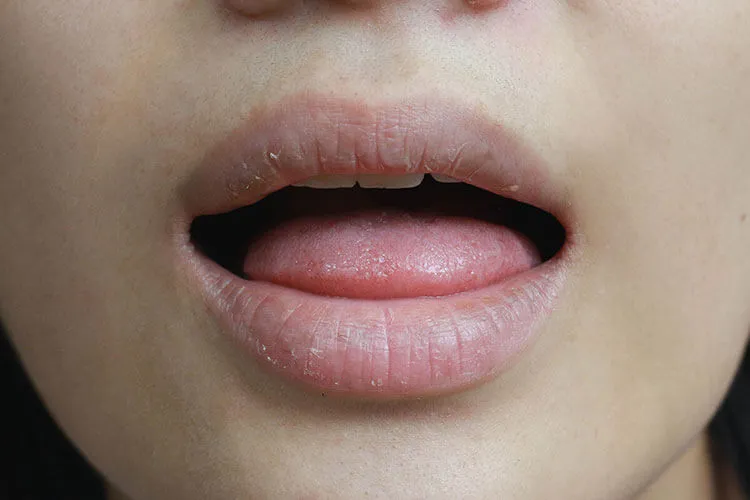 Early Signs of Dry Mouth