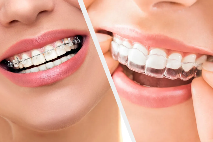 invisalign vs braces