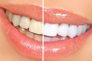 How Long Does Teeth Whitening Last?